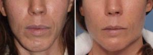 Chin and Jaw Angle Reshaping result front view Dr Barry Eppley Indianapolis