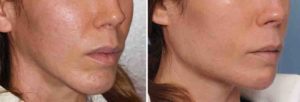 Chin and Jaw Angle Reshaping result oblique view Dr Barry Eppley Indianapolis