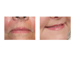 Corner of Mouth Lift result Indianapolis Dr Barry Eppley