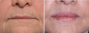 Corner of Mouth Lift result front view