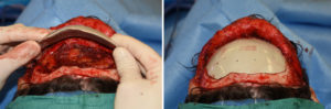Custom Forehead Implant Reconstruction intraop Dr Barry Eppley Indianapolis