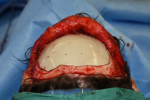 Custom Forehead Skull Implant Reconstruction Dr Barry Eppley Indianapolis