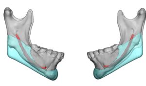 Custom Jawline Implant design for Jaw Angle Reconstruction Dr Barry Eppley Indianapolis