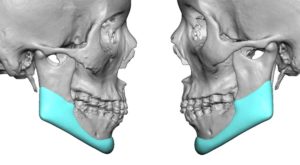 Custom Jawline Implant foir Jawline Reconstruction after Jawline Reduction side view Dr Barry Eppley Indianapolis