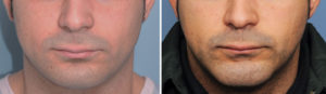 Custom Square Chin Implant front view Dr Barry Eppley Indianapolis