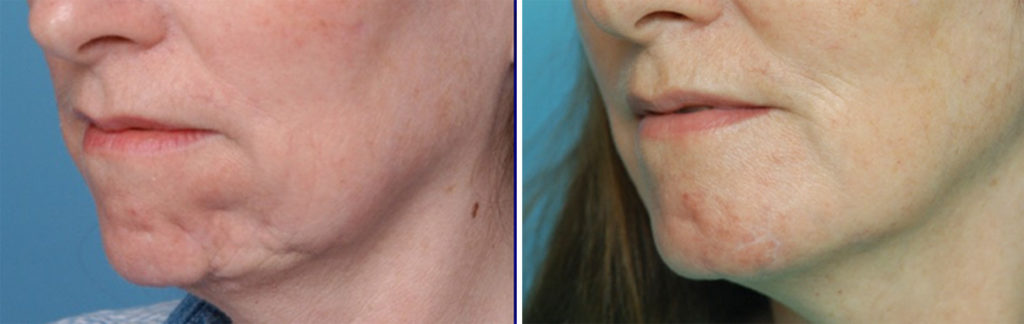 Plastic Surgery Case Study - Dermal-Fat Graft Chin Reconstruction ...