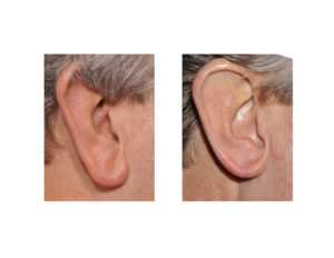 Earlobe Reduction Surgery Dr Barry Eppley Indianapolis