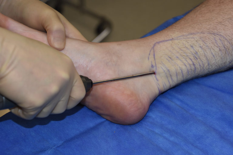 Lower leg case study image