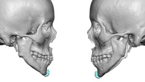 Jawline Deformity after Jaw Angle Amputation