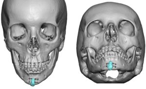Jawline Deformity after Jaw Angle Reduction fronkt view