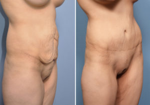 MO Tummy Tuck result oblique view