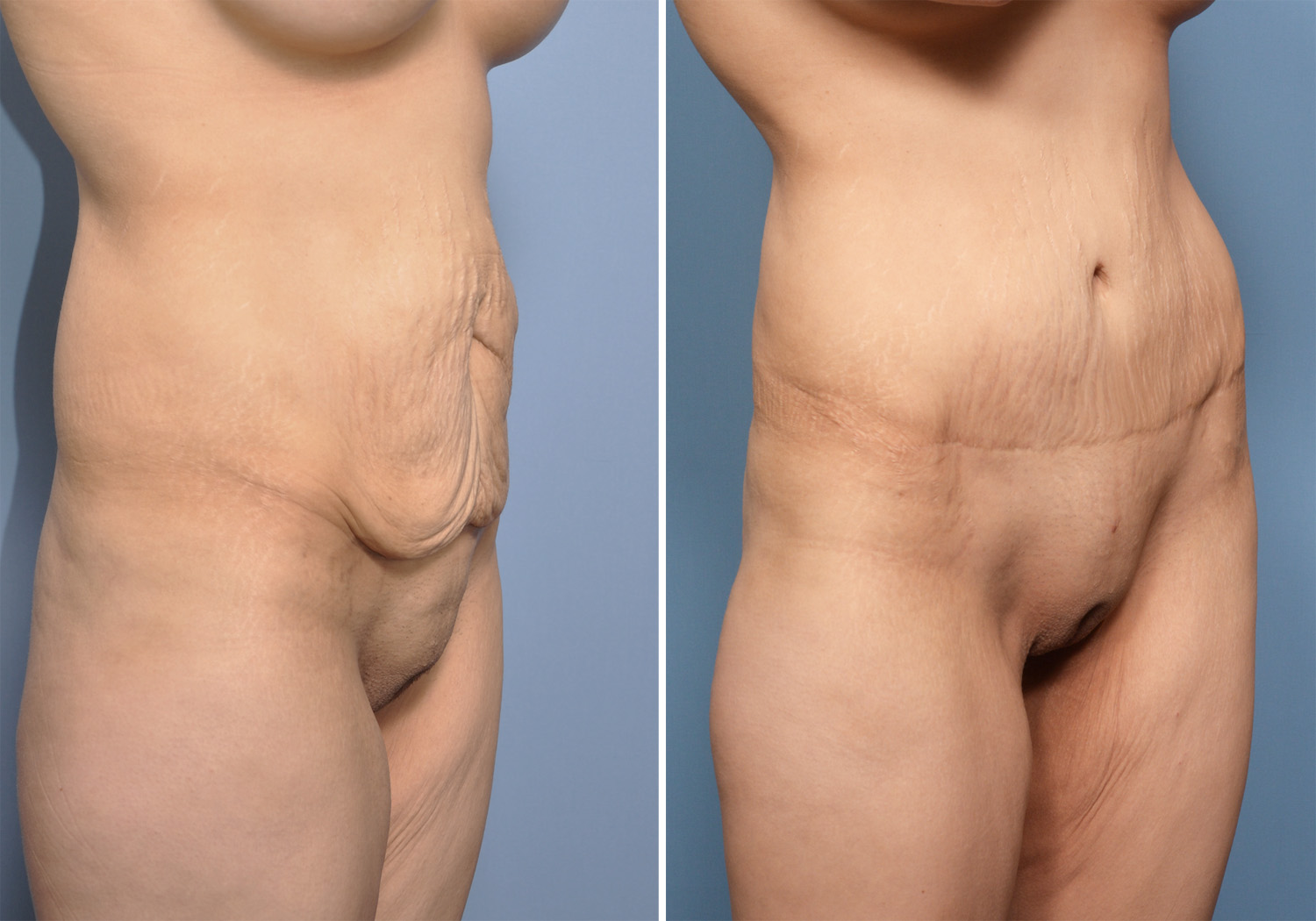 Best breast augmentation san antonio, tx