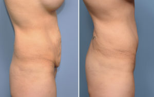 MO Tummy Tuck result side view