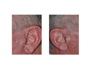 Male Facelift Scars Dr Barry Eppley Indianapolis