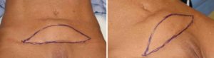 Mini Tummy Tuck Sero0ma Surgery design Dr Barry Eppley Indianapolis