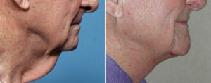 Older Male Direct Necklift result Dr Barry Eppley Indianapolis