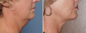 Older Neck Liposuction results side view Dr Barry Eppley Indianapolis