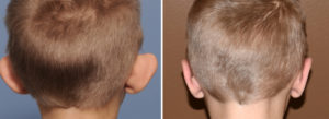 Pediatric Otoplasty result back view Dr Barry Eppley Indianapolis