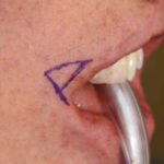 Pennant Corner of the Mouth Lift Dr Barry Eppley Indianapolis