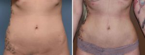 Rib Removal results front view Dr Barry Eppley Indianapolis