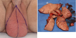 Scrotal Skin Removal