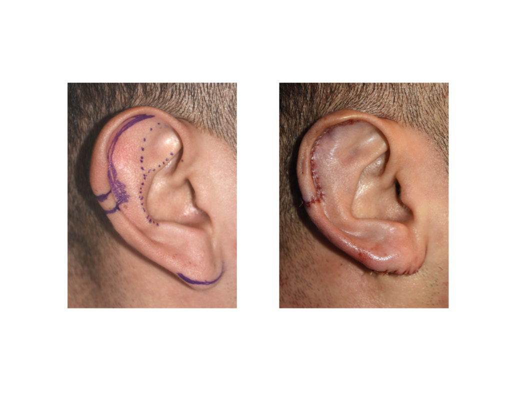 Combining Vertical Ear Reduction with Setback Otoplasty Explore