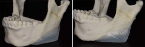 Vertical lengthening jaw angle implants