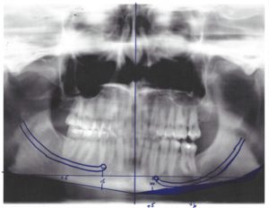 x-ray for Inferior Border Jawline Shave Dr Barry Eppley Indianapolis