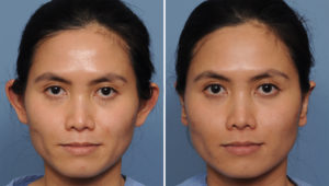 Asian Otoplasty results front view Dr Barry Eppley Indianapolis