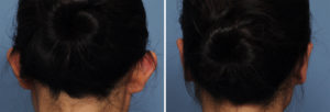 Asianj Otoplasty results back view Dr Barry Eppley Indianapolis