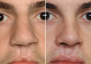 Bilateral Cleft Septorhinoplasty result front view Dr Barry Eppley Indianapolios