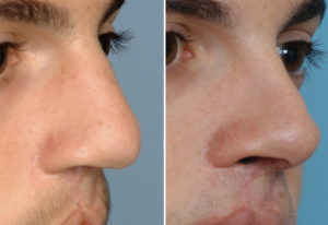 Bilateral Cleft Septorhinoplasty result oblique view Dr Barry Eppley Indianapolis