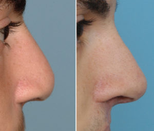 Bllateral Cleft Septorhinoplasty result side view Dr Barry Eppley Indianapolis