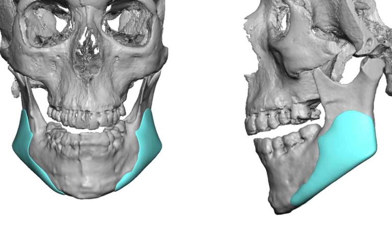 Custom Extended Vertical Jaw Angle Imlpants design Dr Barry Eppley ...