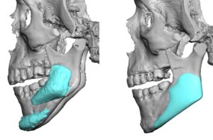 Custom Vertical Jaw Angles vs Standard Widening Jaw Angle Implants Dr Barry Eppley Indianapolis