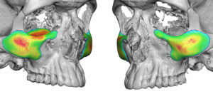 Custyom Cheek Implants with Orbital Floor Implant design Dr Barry Eppley Indianapolis