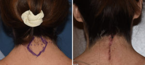 JV Webbed Neck Correction result back view Dr Barry Eppley Indianapolis