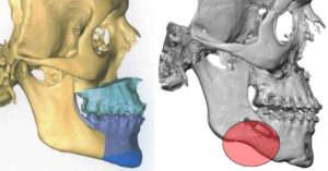 Jawline Irregularities after Sagittal Split Osteotomies Dr Barry Eppley Indianapolis