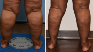 Large Cankle Liposuction back view Dr Barry Eppley Indianapolis