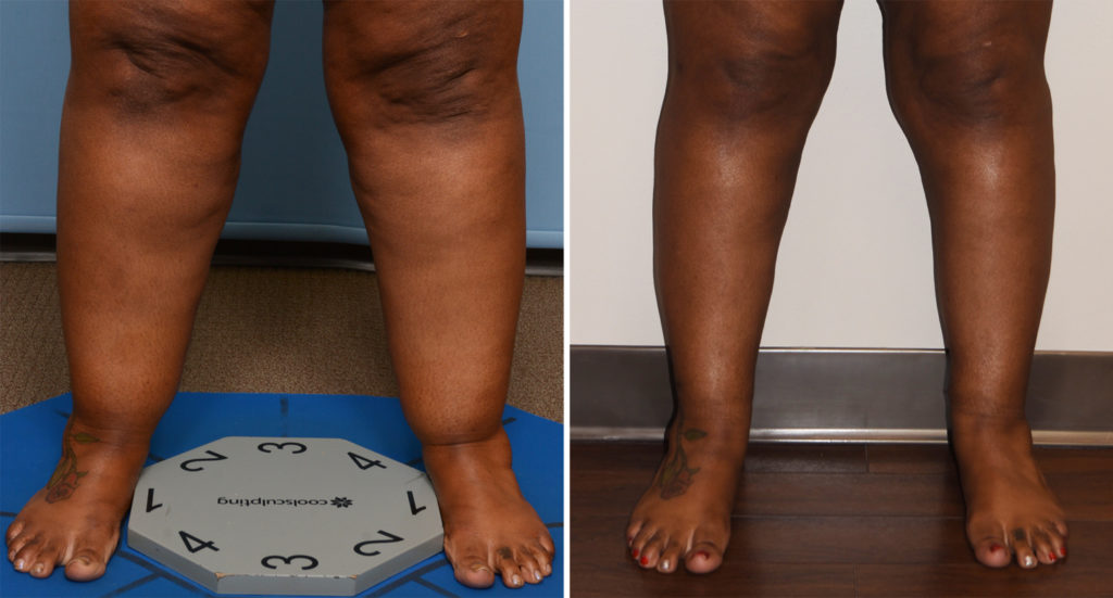 Plastic Surgery Case Study Large Cankle Liposuction Explore Plastic