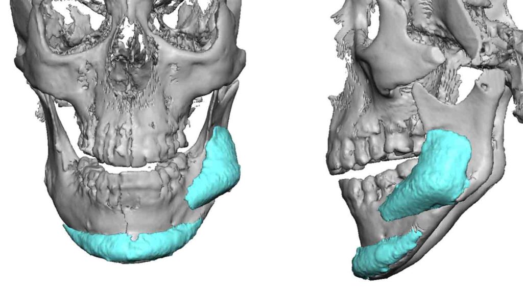 Plastic Surgery Case Study - Combining Custom Jaw Angle Implants with ...