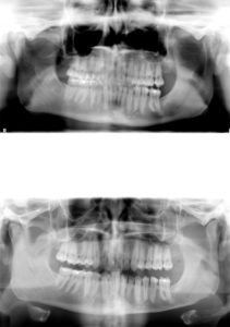 Mandibular Inferior Border Shave Dr Barry Eppley Indianapolis