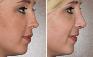 Rhinoplasty splint removal side view Dr Barry Eppley Indianapolis