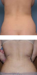 Rib Removal for Waistline Narrowing Dr Barry Eppley Indianapolis