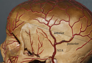 Superficial Temporal Artery Anatomy Dr Barry Eppley Indianapolis