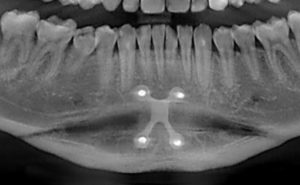 Vertical Lengthening Genioplasty witrh Interposition Graft x-ray Dr Barry Eppley Indianapolis