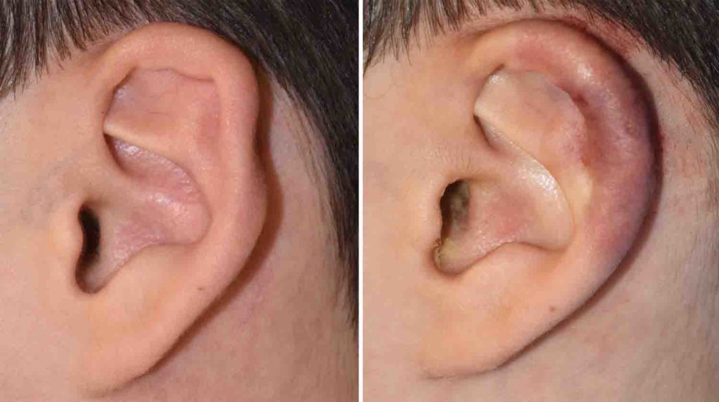 Left Constricted Ear Deformity Correction with Rib Graft intraop Dr