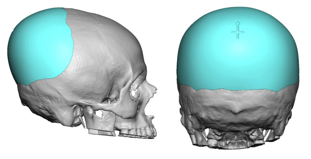 Custom Occipital Skull Implant Design Dr Barry Eppley Indianapolis
