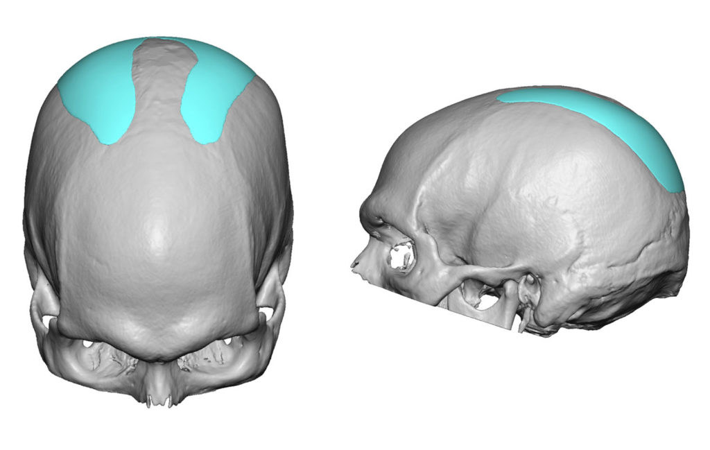 Plastic Surgery Case Study Custom Occipital Parasagittal Skull