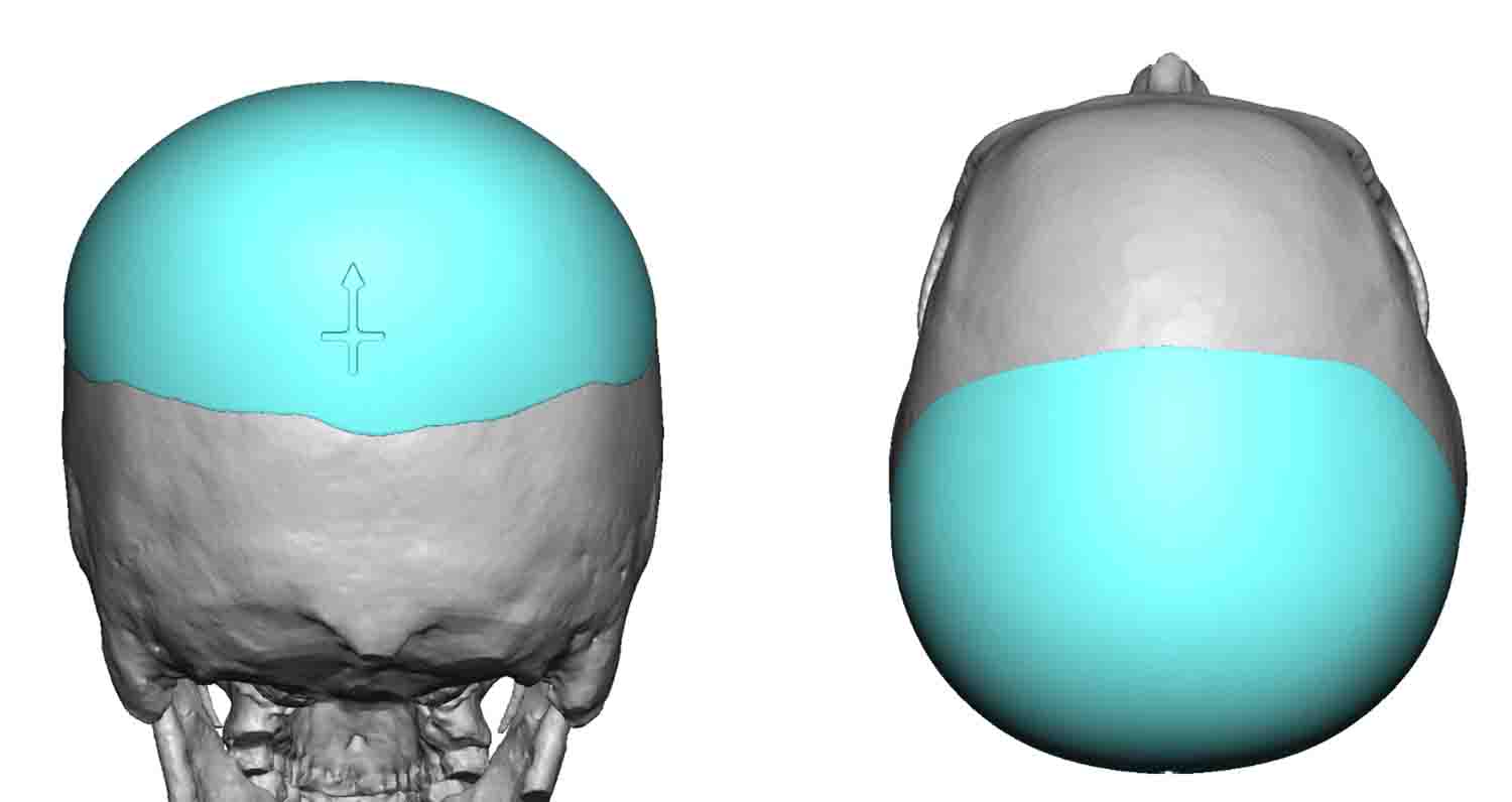 Blog Archivecase Study Custom Occipital Skull Implant Markers